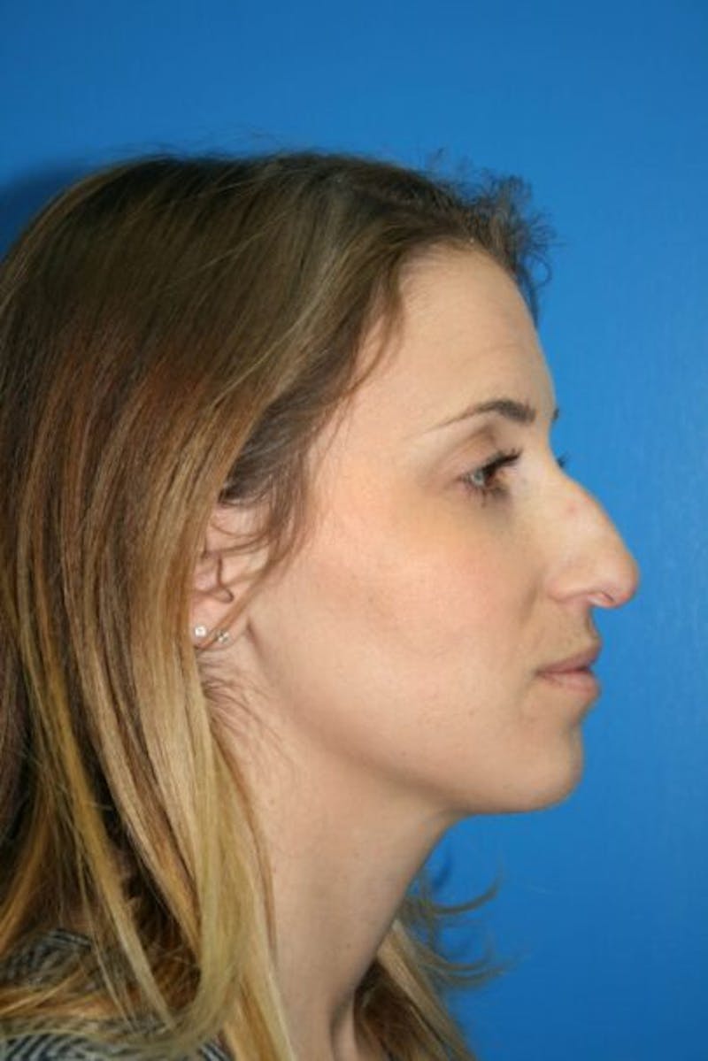 Rhinoplasty Before & After Gallery - Patient 428725 - Image 3