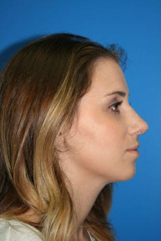 Rhinoplasty Before & After Gallery - Patient 428725 - Image 4