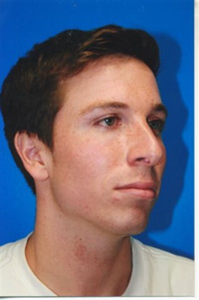 Rhinoplasty Before & After Gallery - Patient 290657 - Image 1