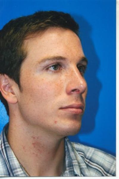 Rhinoplasty Before & After Gallery - Patient 290657 - Image 2