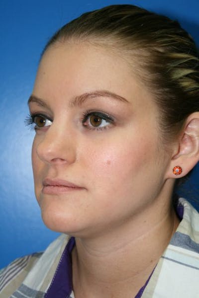 Rhinoplasty Before & After Gallery - Patient 394178 - Image 1
