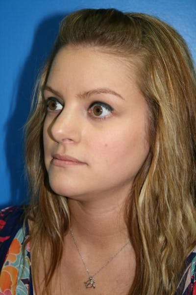 Rhinoplasty Before & After Gallery - Patient 394178 - Image 2