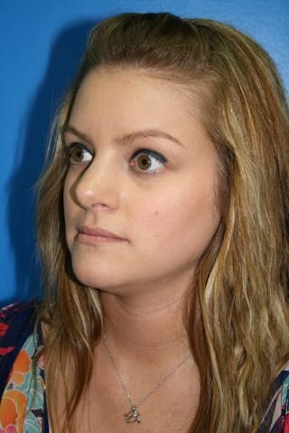 Rhinoplasty Before & After Gallery - Patient 394178 - Image 2