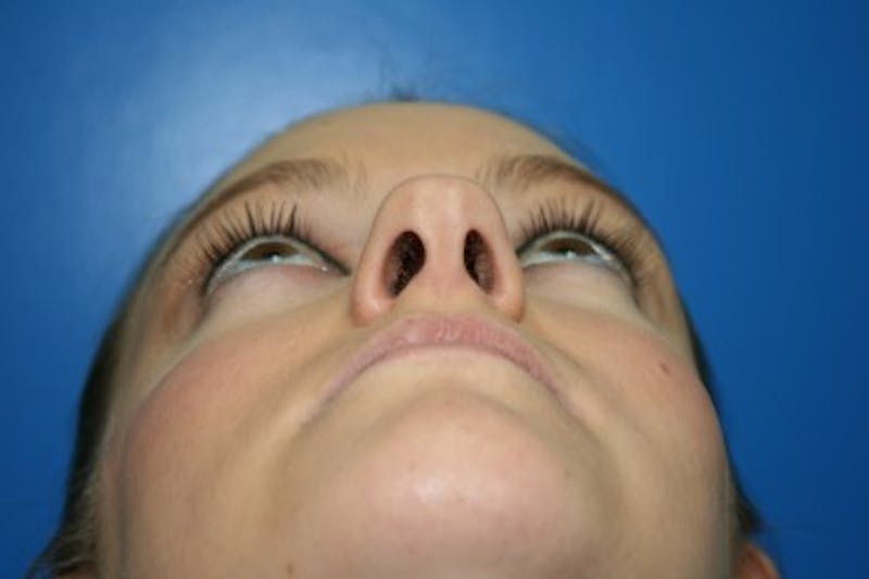Rhinoplasty Before & After Gallery - Patient 394178 - Image 3