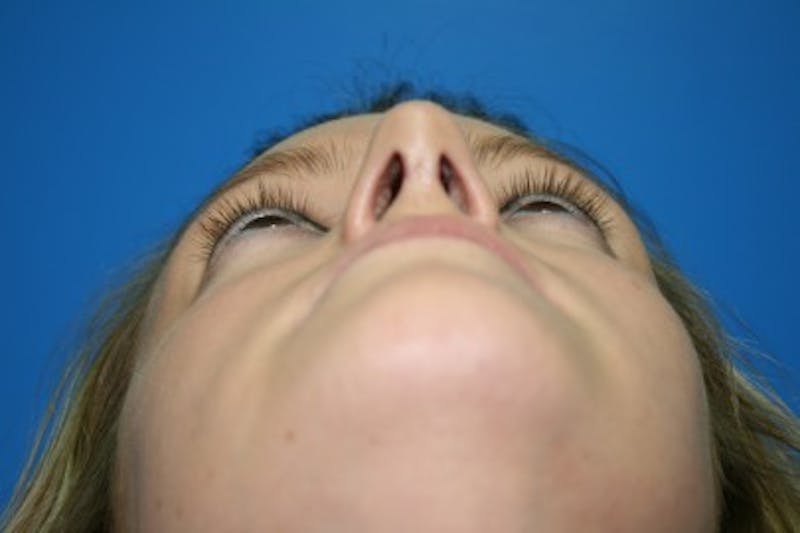 Rhinoplasty Before & After Gallery - Patient 394178 - Image 4