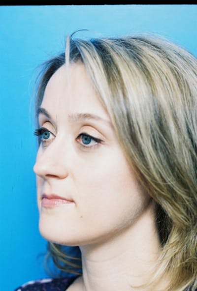 Rhinoplasty Before & After Gallery - Patient 147257 - Image 1