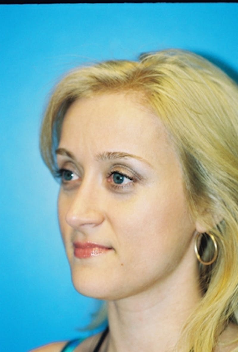 Rhinoplasty Before & After Gallery - Patient 147257 - Image 2