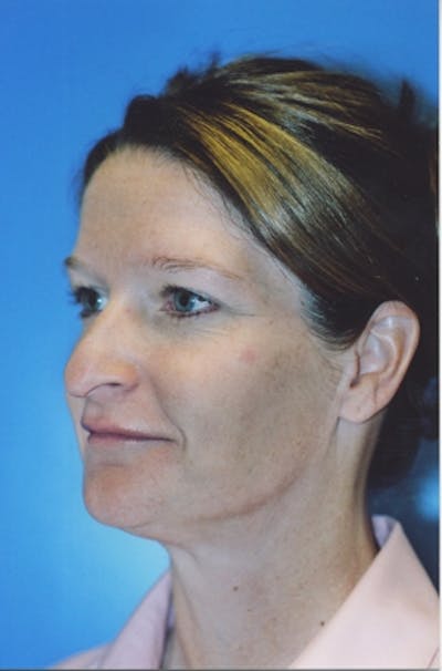Rhinoplasty Before & After Gallery - Patient 465348 - Image 1