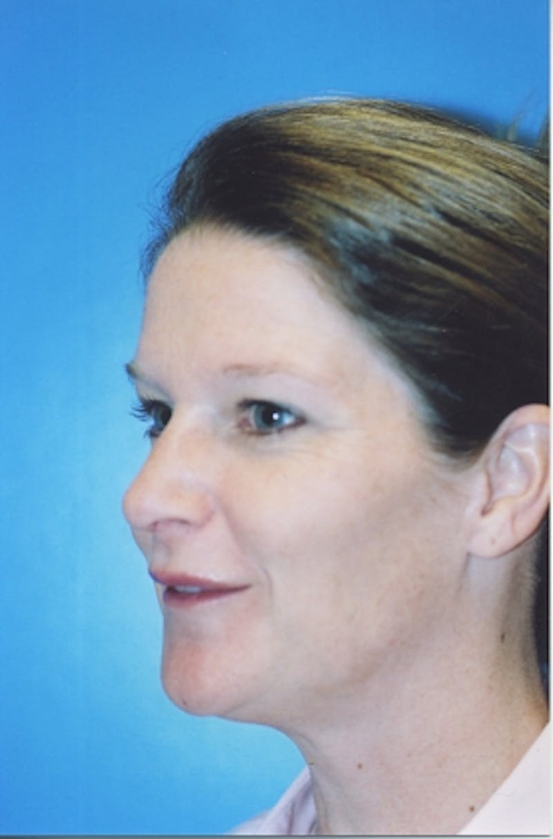 Rhinoplasty Before & After Gallery - Patient 465348 - Image 2