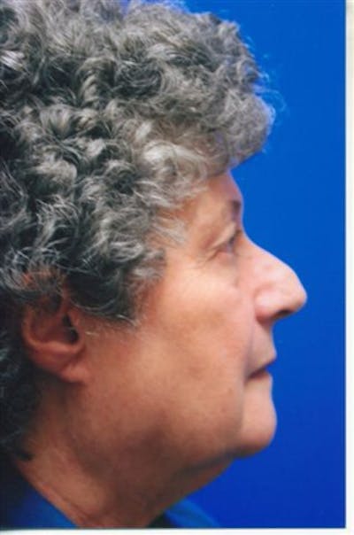 Rhinoplasty Before & After Gallery - Patient 363994 - Image 1