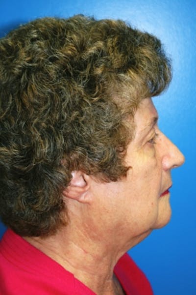 Rhinoplasty Before & After Gallery - Patient 363994 - Image 2