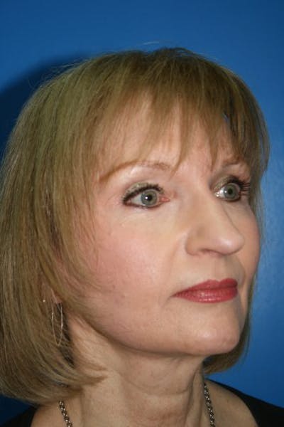 Rhinoplasty Before & After Gallery - Patient 241215 - Image 1