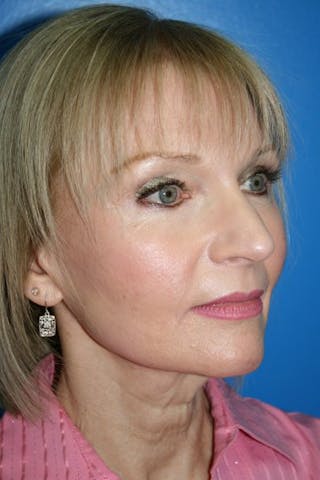 Rhinoplasty Before & After Gallery - Patient 241215 - Image 2