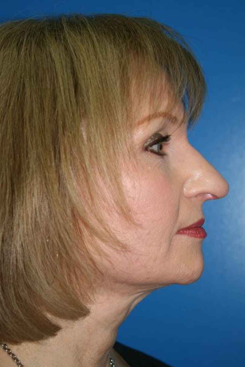 Rhinoplasty Before & After Gallery - Patient 241215 - Image 3