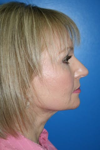 Rhinoplasty Before & After Gallery - Patient 241215 - Image 4