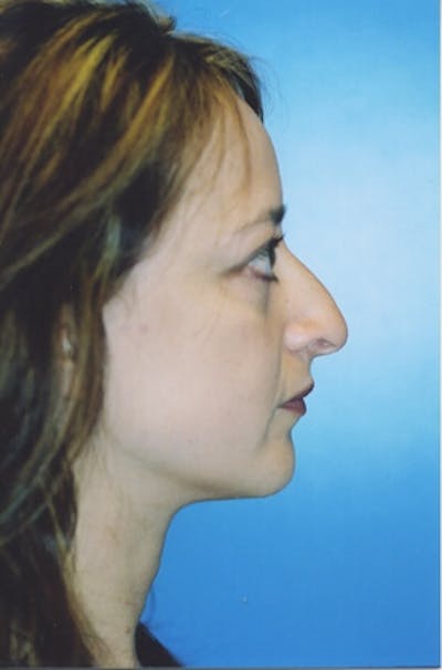 Rhinoplasty Before & After Gallery - Patient 287318 - Image 1
