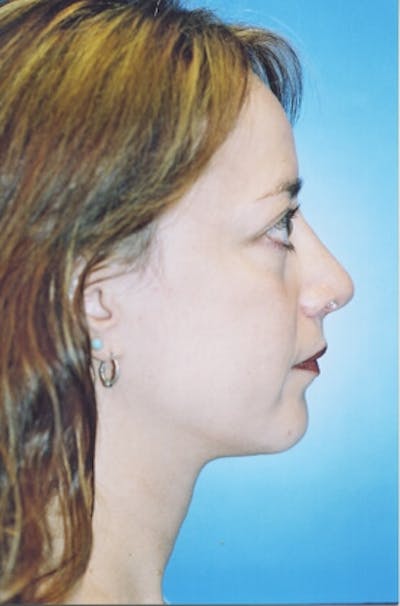 Rhinoplasty Before & After Gallery - Patient 287318 - Image 2