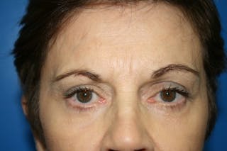 Brow Lift / Forehead Lift Before & After Gallery - Patient 258612 - Image 2