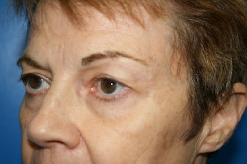 Brow Lift / Forehead Lift Before & After Gallery - Patient 258612 - Image 3