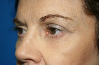 Brow Lift / Forehead Lift Before & After Gallery - Patient 258612 - Image 4