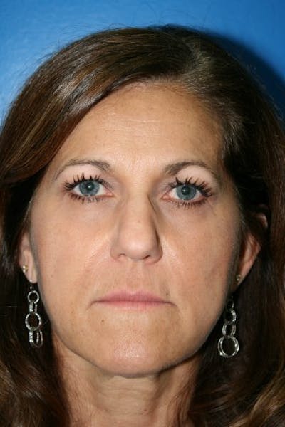 Brow Lift / Forehead Lift Before & After Gallery - Patient 105440 - Image 1
