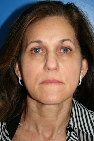 Brow Lift / Forehead Lift Before & After Gallery - Patient 105440 - Image 2