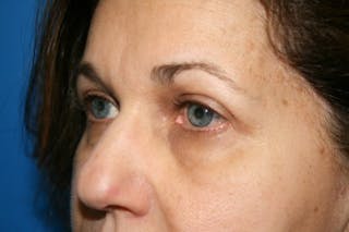 Brow Lift / Forehead Lift Before & After Gallery - Patient 105440 - Image 4