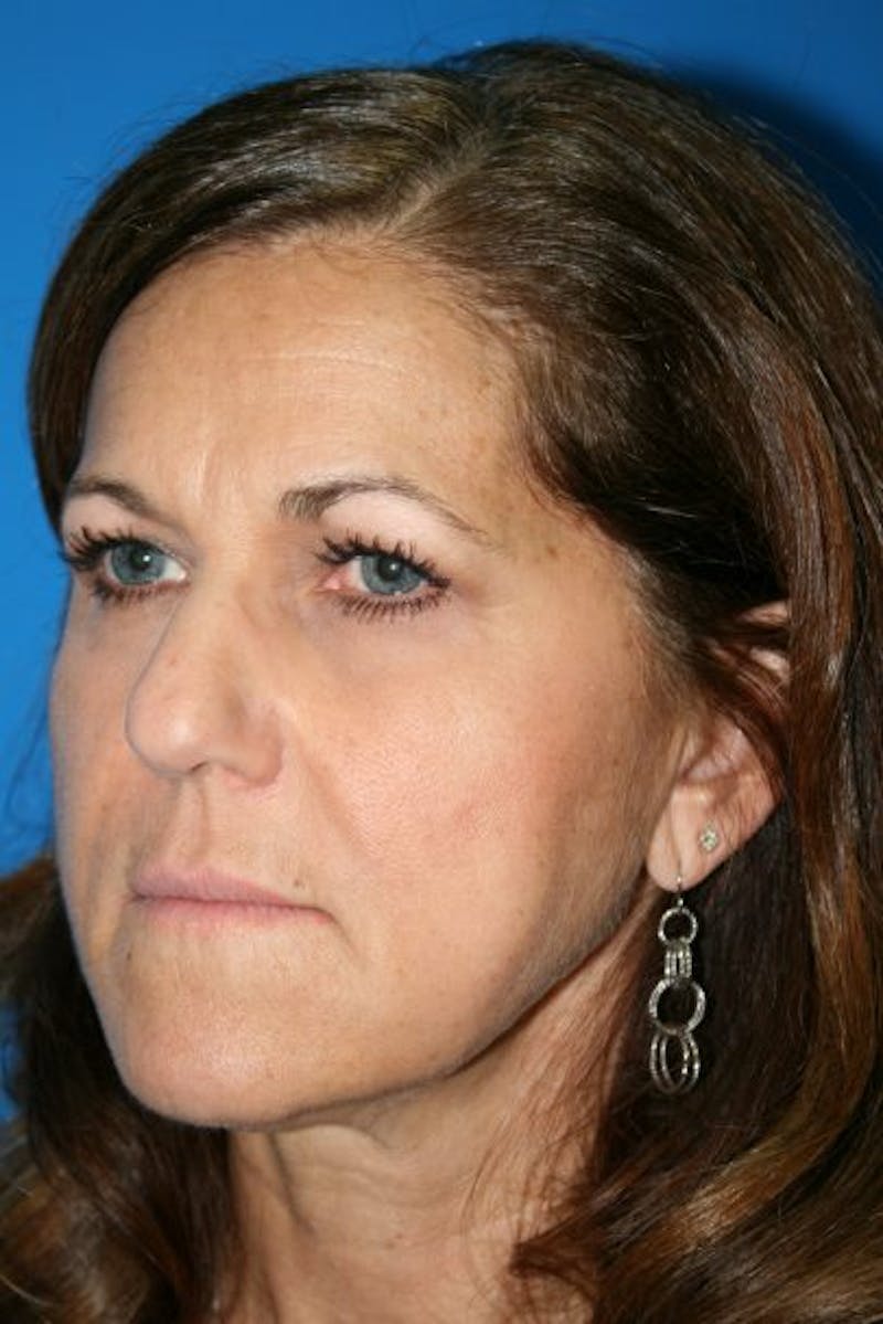 Brow Lift / Forehead Lift Before & After Gallery - Patient 105440 - Image 5