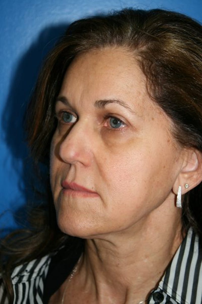 Brow Lift / Forehead Lift Before & After Gallery - Patient 105440 - Image 6