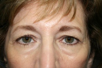 Brow Lift / Forehead Lift Before & After Gallery - Patient 246565 - Image 1