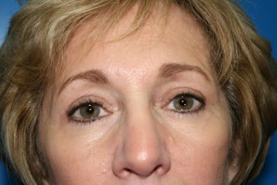 Brow Lift / Forehead Lift Before & After Gallery - Patient 246565 - Image 2