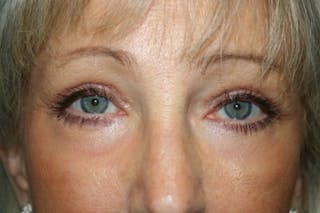 Brow Lift / Forehead Lift Before & After Gallery - Patient 334487 - Image 4