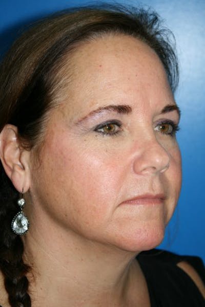 Brow Lift / Forehead Lift Before & After Gallery - Patient 340626 - Image 1