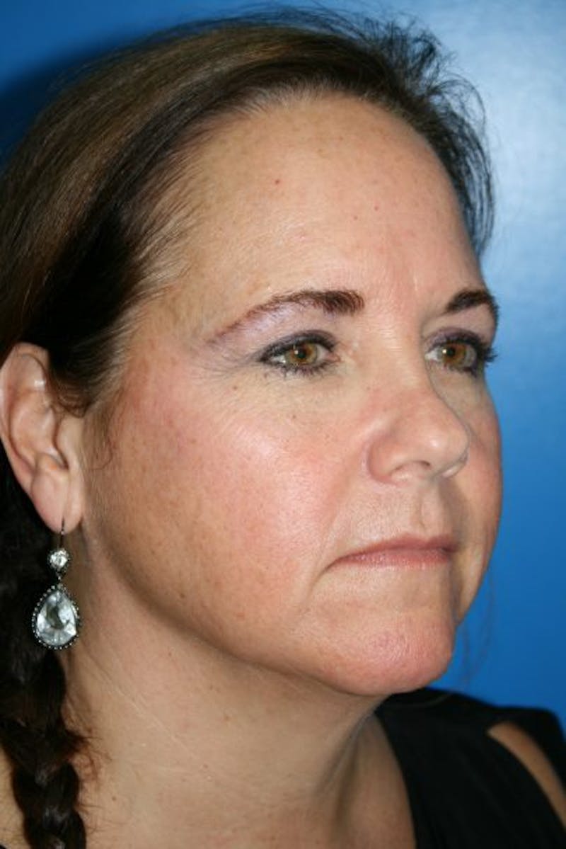 Brow Lift / Forehead Lift Before & After Gallery - Patient 340626 - Image 1