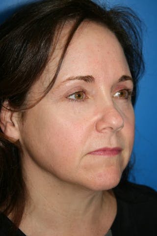 Brow Lift / Forehead Lift Before & After Gallery - Patient 340626 - Image 2