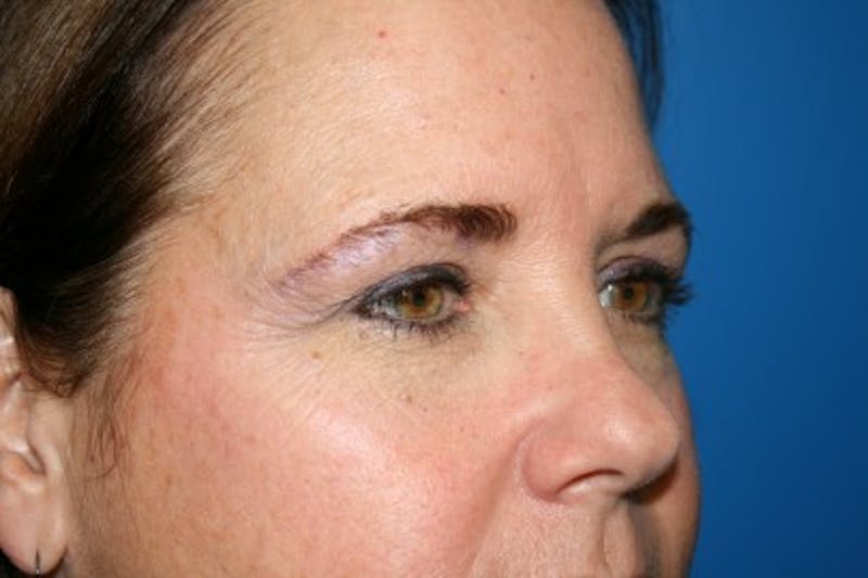 Brow Lift / Forehead Lift Before & After Gallery - Patient 340626 - Image 3