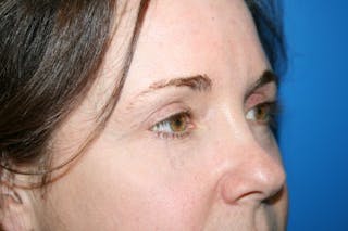 Brow Lift / Forehead Lift Before & After Gallery - Patient 340626 - Image 4