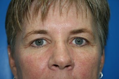 Brow Lift / Forehead Lift Before & After Gallery - Patient 998873 - Image 1