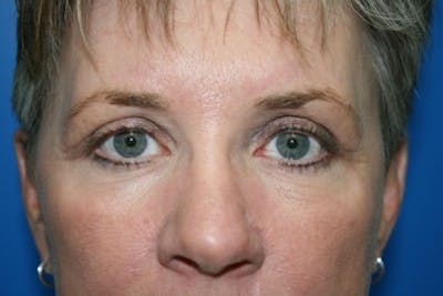 Brow Lift / Forehead Lift Before & After Gallery - Patient 998873 - Image 2