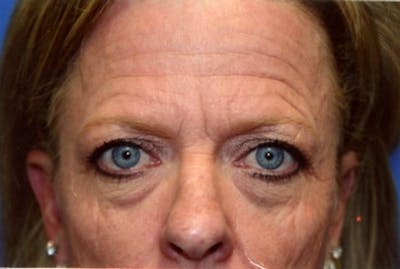 Brow Lift / Forehead Lift Before & After Gallery - Patient 286554 - Image 1