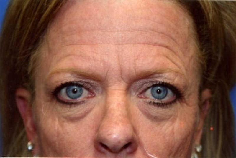 Brow Lift / Forehead Lift Before & After Gallery - Patient 286554 - Image 1