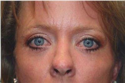 Brow Lift / Forehead Lift Before & After Gallery - Patient 286554 - Image 2