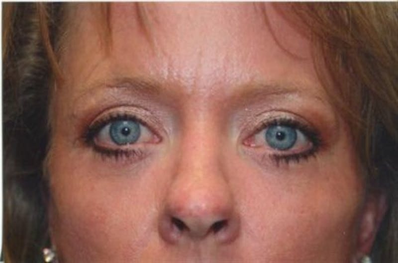 Brow Lift / Forehead Lift Before & After Gallery - Patient 286554 - Image 2