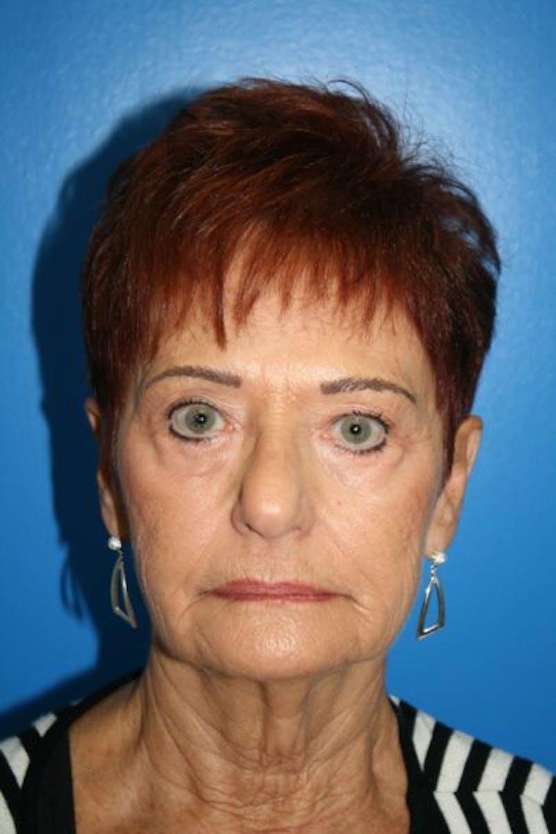 Laser Skin Resurfacing Before & After Gallery - Patient 112928 - Image 1