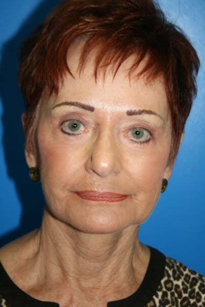 Laser Skin Resurfacing Before & After Gallery - Patient 112928 - Image 2
