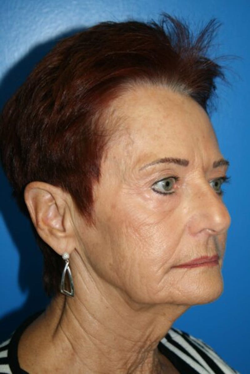 Laser Skin Resurfacing Before & After Gallery - Patient 112928 - Image 3