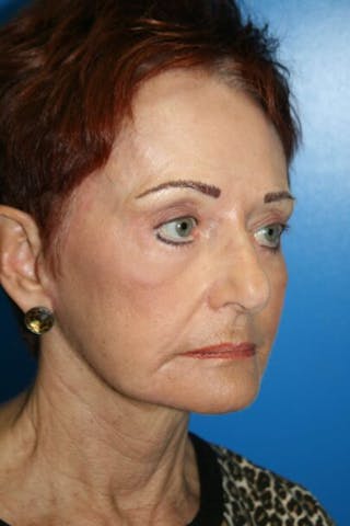 Laser Skin Resurfacing Before & After Gallery - Patient 112928 - Image 4