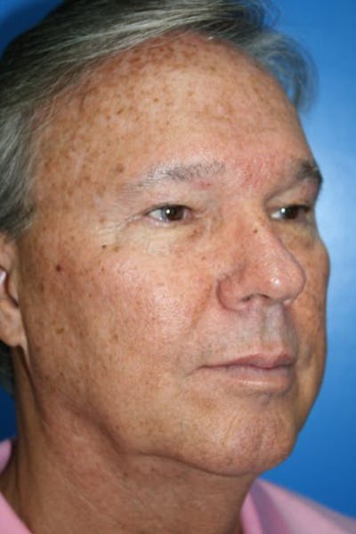 Laser Skin Resurfacing Before & After Gallery - Patient 278391 - Image 1