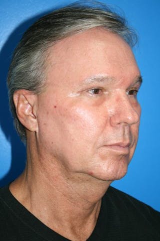 Laser Skin Resurfacing Before & After Gallery - Patient 278391 - Image 2