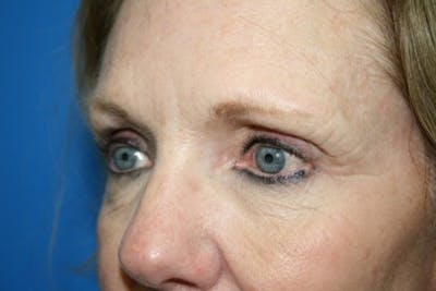 Laser Skin Resurfacing Before & After Gallery - Patient 223623 - Image 1